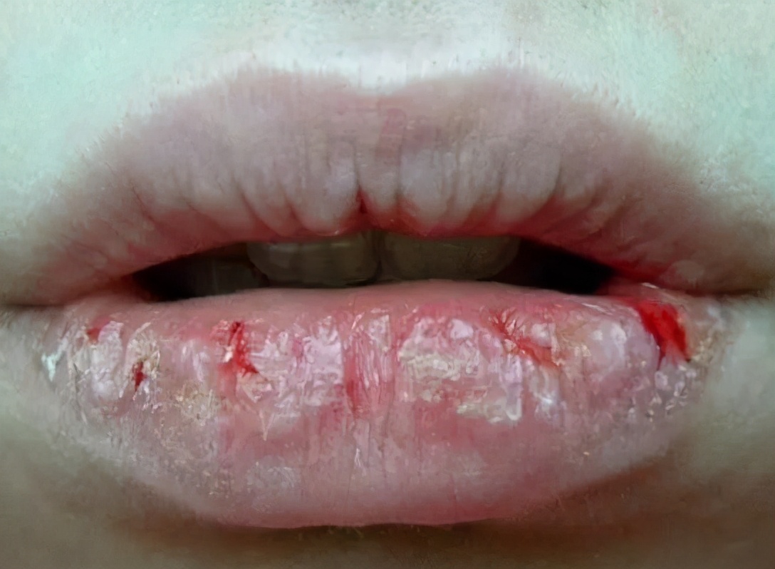 唇炎干裂脱皮怎么治,唇部干裂唇炎图片