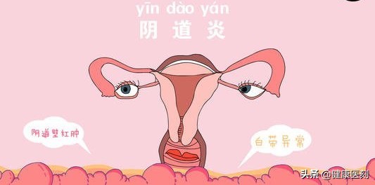 女性容易得阴道炎是啥原因,反复发作的阴道炎需要怎么用药