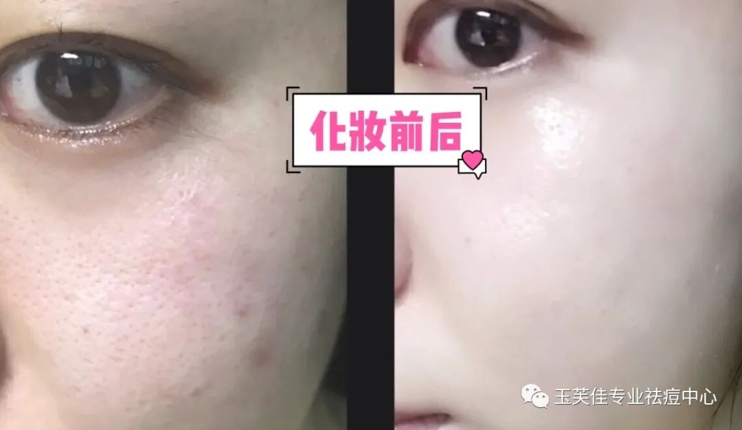 痘痘肌化妆教程用什么颜色遮瑕,痘痘肌化妆教程初学者淡妆