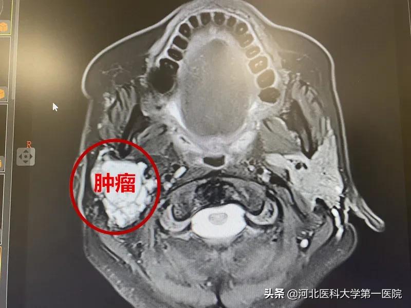 神奇魔法刀，一点就消！点亮肿瘤绝境患者，再生的希望之光