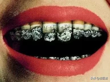 牙周炎才是牙齿松动的罪魁祸首,牙周炎导致全部牙齿脱落镶什么牙