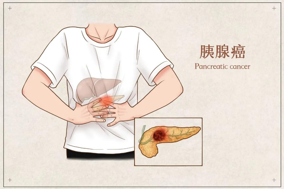 癌中之王胰腺癌近期研究进展一览,免疫疗法治疗胰腺癌晚期癌症