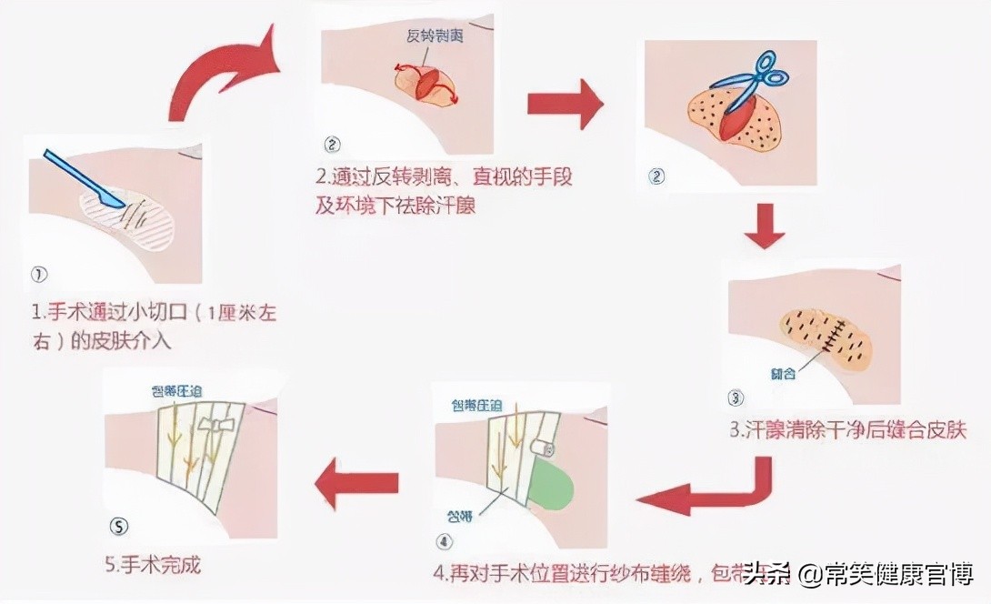 腋臭严重做哪种手术比较好,腋臭微创方法