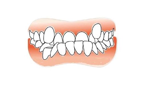 整牙的过程中还能拔牙吗,不想拔牙怎样把牙弄掉