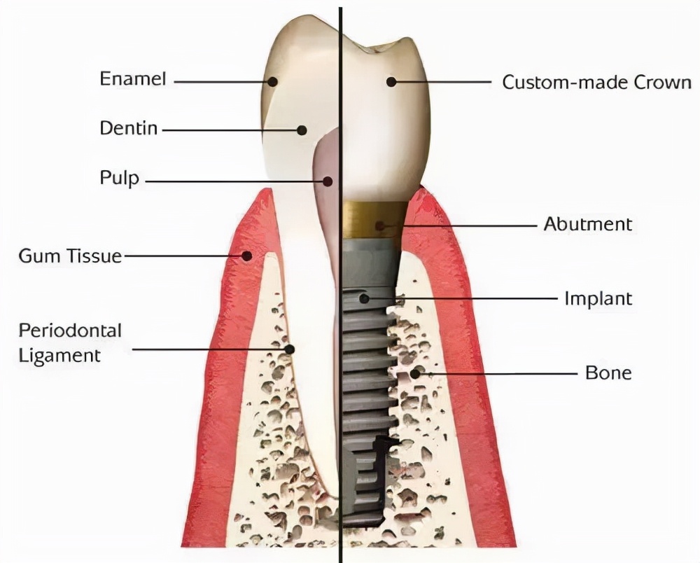 咬硬物折断牙，该拔还是该治？
