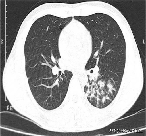 支气管肺炎x线影像,影像学肺炎与支气管炎的描述