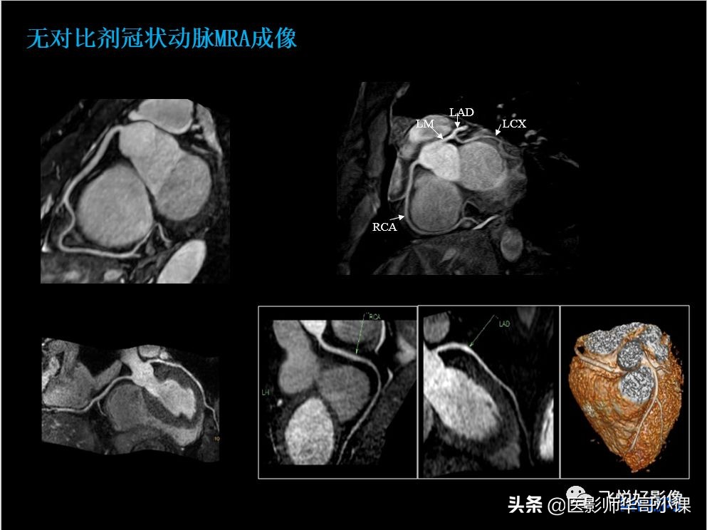 飞利浦核磁共振快速扫描,飞利浦磁共振心脏扫描