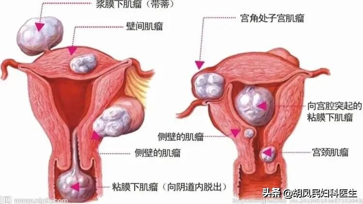 子宫肌瘤出血吃止血药好不好,子宫异常出血警惕是子宫肌瘤