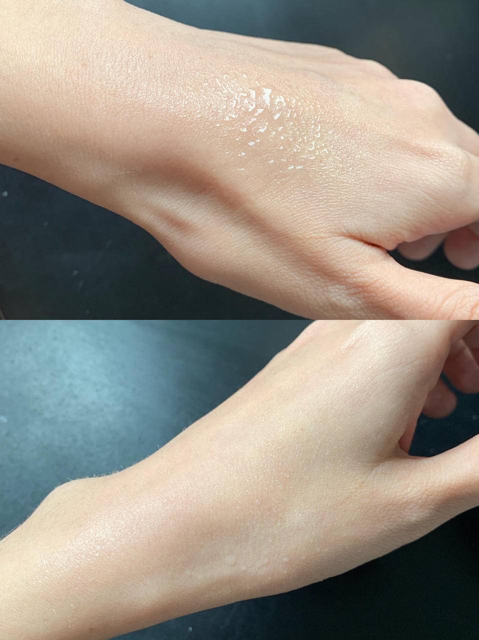 晒后皮肤疼如何快速修复,晒伤后出的晒痕如何处理