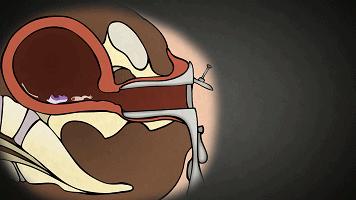 为什么那么多人避孕失败,中国十大避孕失败案例