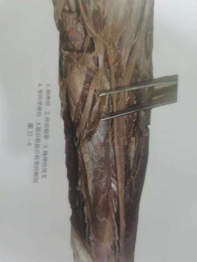 手肘忽然酸痛怎么缓解,手肘酸痛怎么办最快解决方法