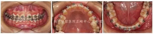 牙齿深覆合对脸型的影响,覆合型牙齿是怎么造成的