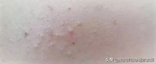 改善闭口痘痘的方法,去闭口痘最好的方法