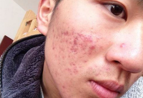 脸上有痘印怎样遮痘不显厚,脸上的痘印用遮瑕怎么遮