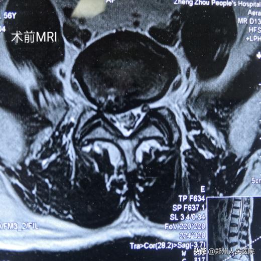 对骨科微创技术的认识,骨科手术与保守治疗对比