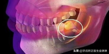 智齿疼吃什么止疼药效果好,智齿疼吃什么药可以快速缓解止疼