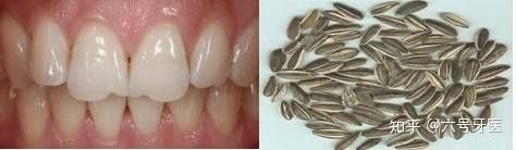 过年嗑瓜子多了好吗,嗑瓜子过年必备