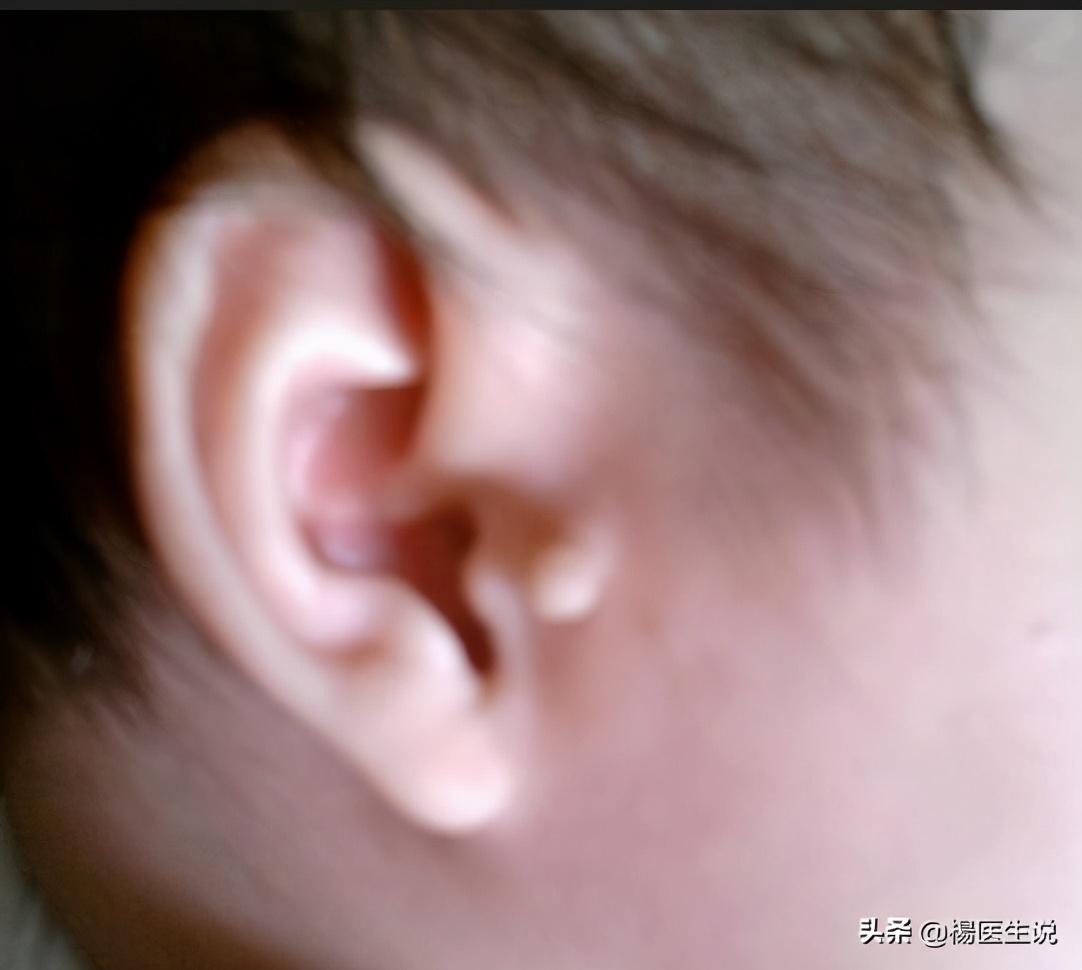 耳朵后面长了个肉瘤是怎么回事,耳朵上长了一个小肉瘤