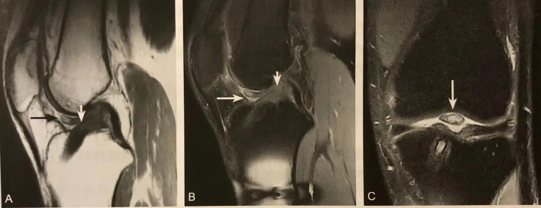 膝关节常见损伤的检查方法,膝关节损伤病例图片