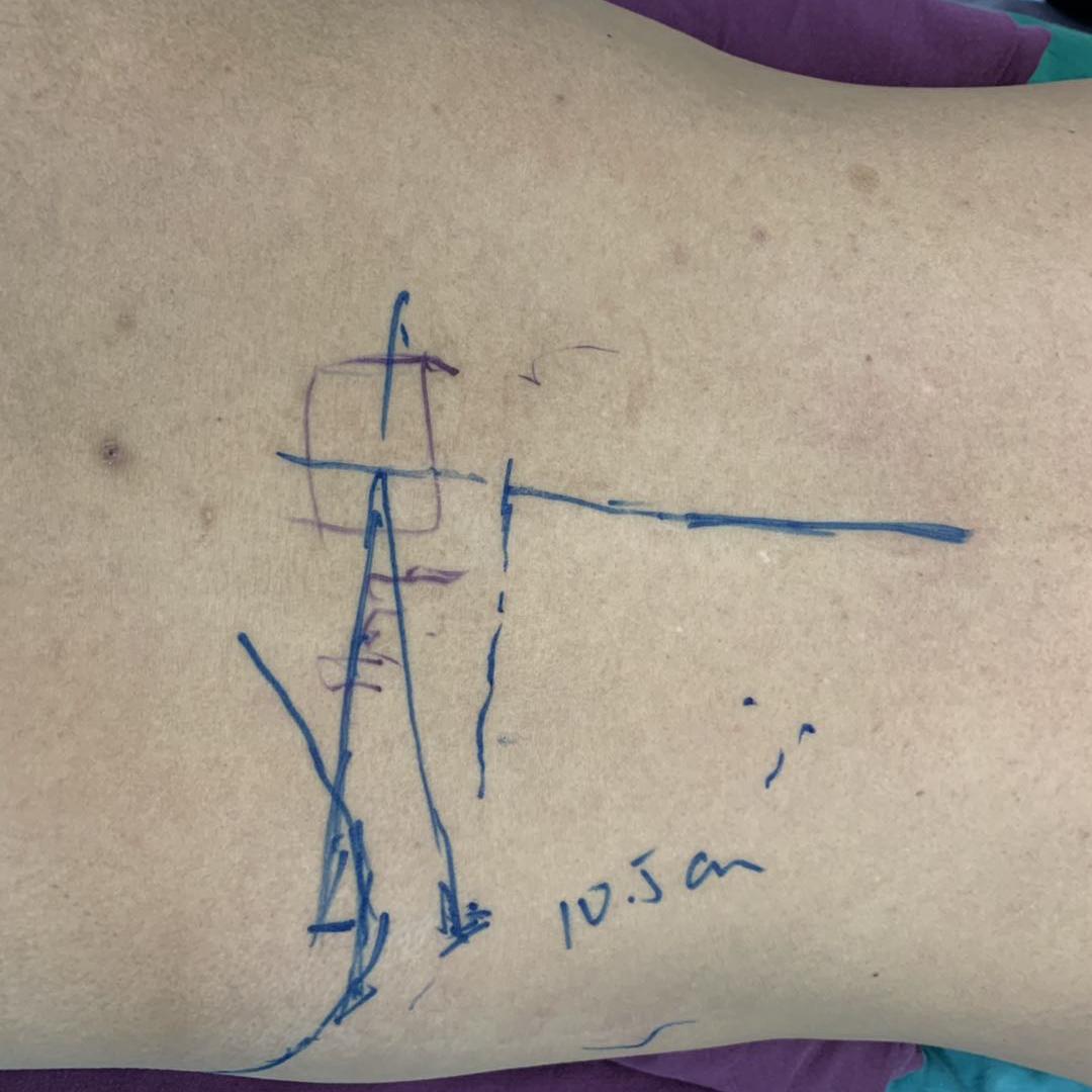 椎孔镜技术治疗颈椎间盘突出,椎间孔镜前沿技术