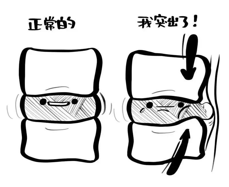 腰突脊柱侧弯最好的恢复方法,腰突为什么会引起侧弯