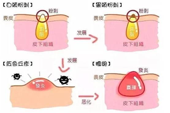 女生闭口粉刺怎么办,有闭口粉刺做什么医美