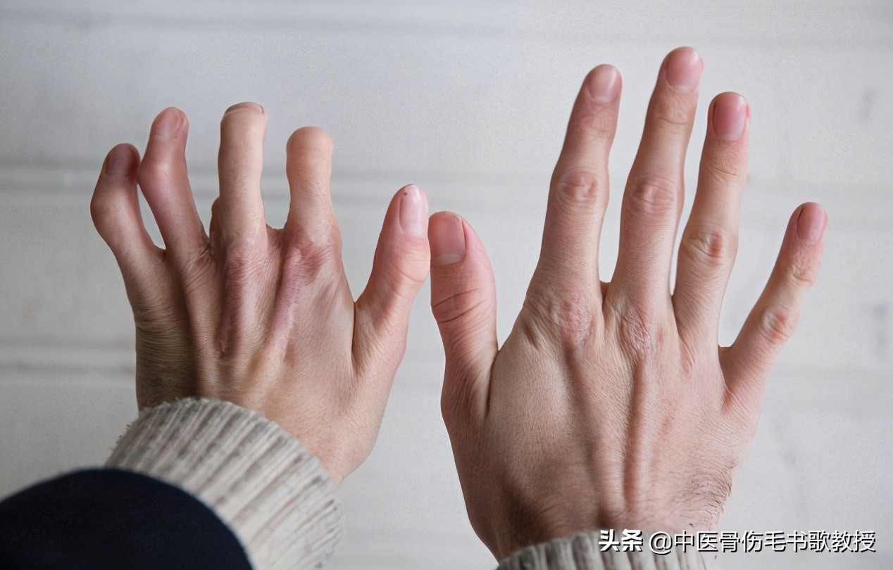 手指关节痛属于风湿还是类风湿,手指关节僵硬膝盖都疼是什么病兆