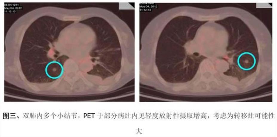 癌症转移无症状,癌症全身转移抗癌成功案例