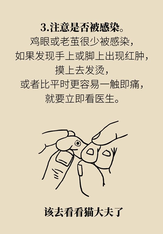 长了鸡眼该怎么办四大妙招教给你,长了鸡眼怎么治疗好得快