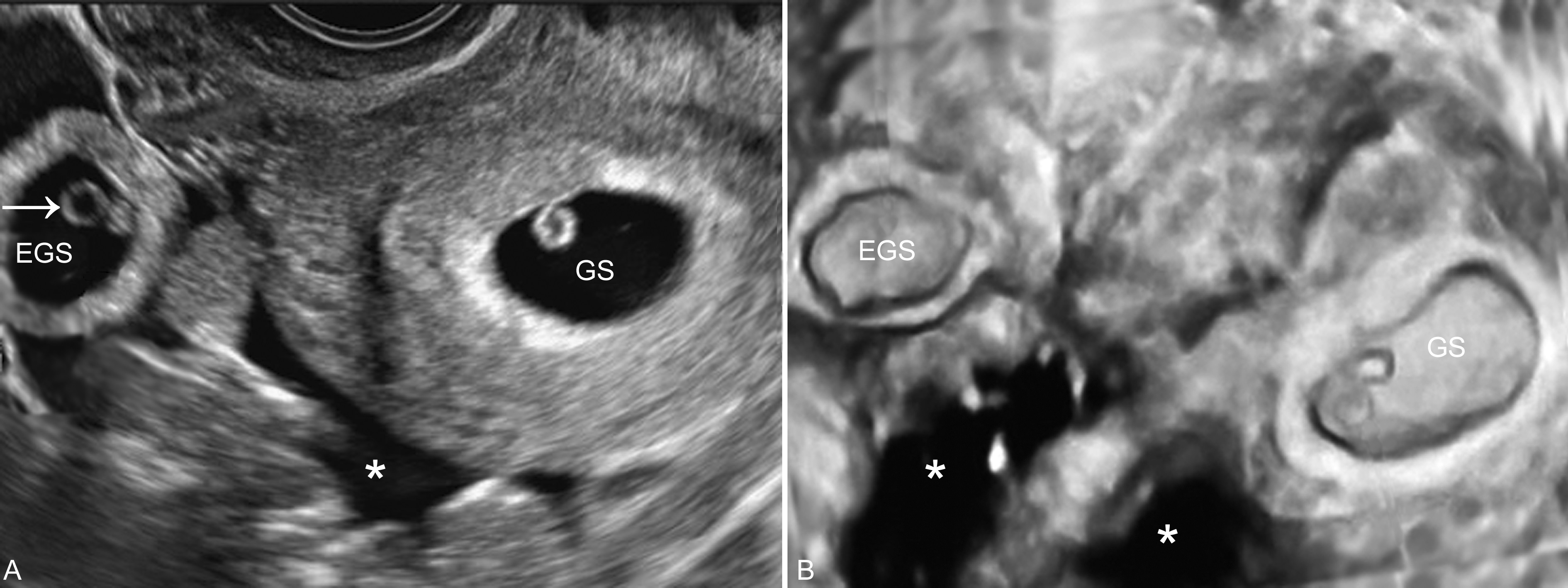 无痛输卵管超声造影全过程图解,输卵管间质部妊娠超声图像