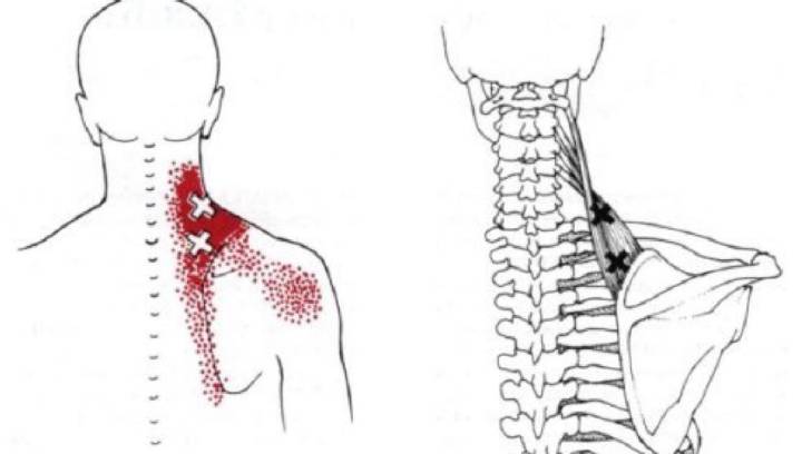 从小就弯腰驼背颈椎病怎么办,16岁颈椎病