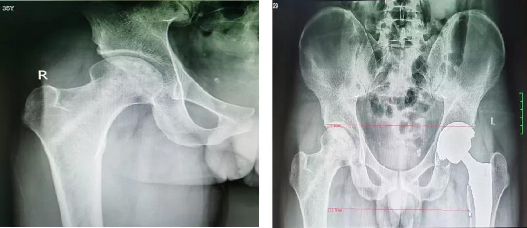 股骨头机器人手术微创,骨科机器人股骨颈手术