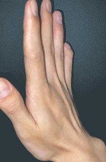 什么能促进手部肌腱断裂自愈,肌腱断裂保守治疗可以自愈吗