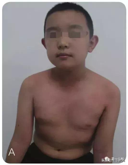 手足口病水痘荨麻疹有什么区别,麻疹水痘手足口病皮疹的区别