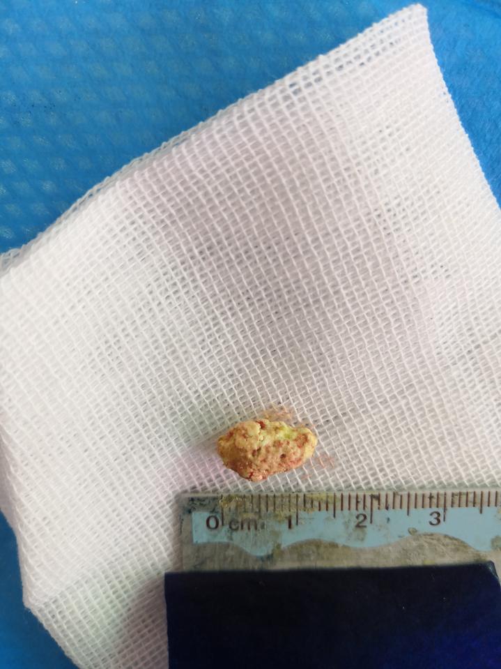 舌头也会长结石！56岁男子因此右脸肿痛，连吃饭都成折磨