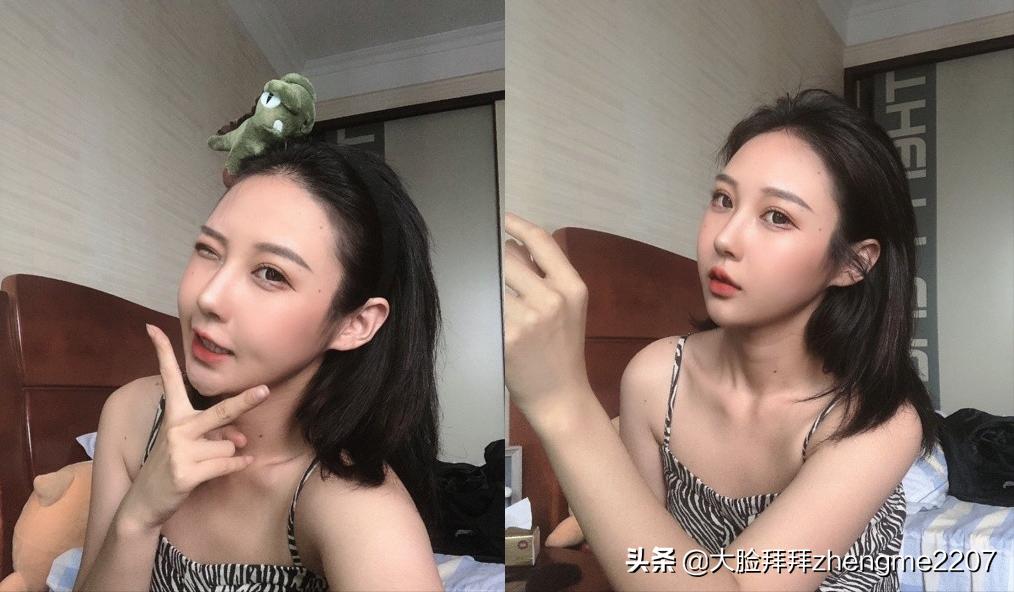 颧骨颧弓内推手术全过程真人,颧骨内推颧弓手术恢复全过程分享