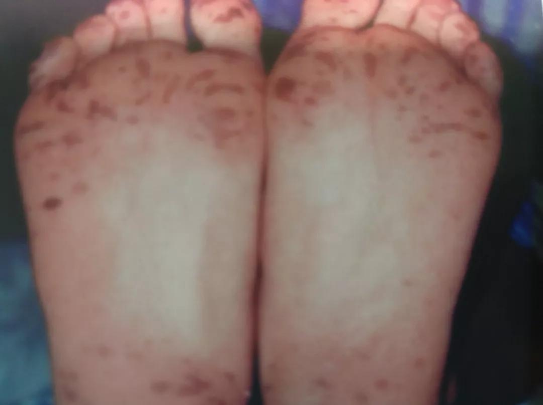 小孩嘴唇长黑斑是怎么回事,小孩嘴唇黑有什么病