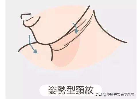 你的脖子比脸更显老，出现颈纹该怎么