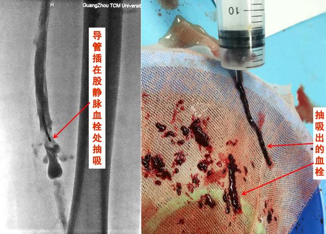 看过来，看过来！静脉曲张与静脉血栓到底有什么区别和联系？
