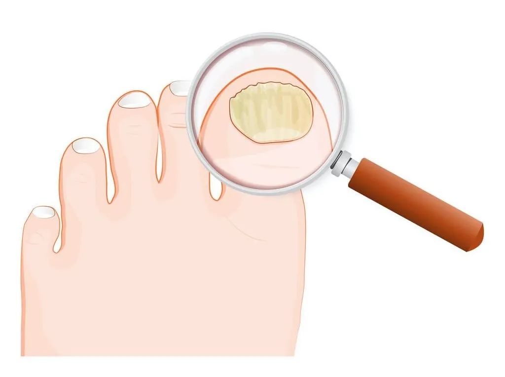 指甲出现白线月牙型的是怎么回事,指甲发白有竖纹是身体缺什么