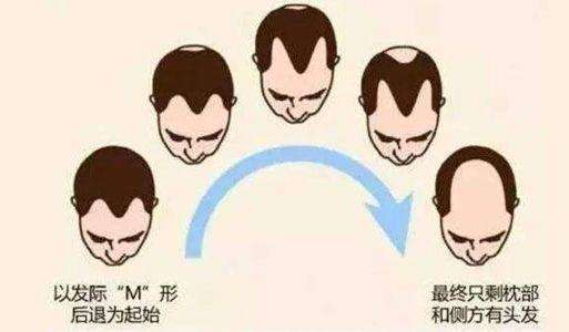 秃发前期头发的样子,斑秃脱发发根又细又白