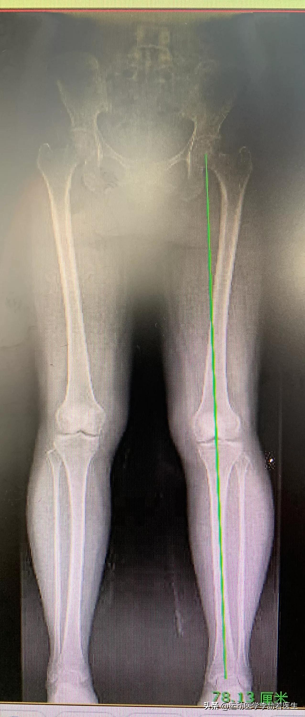 骨关节炎如何彻底治好,骨关节炎怎么治疗最好最有效