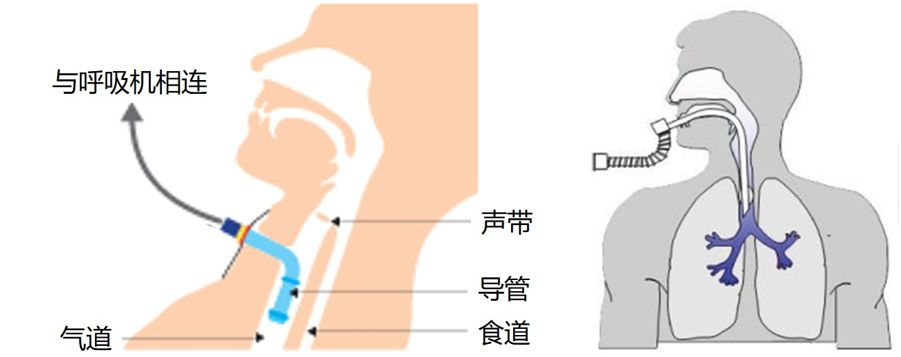 感染病毒，死于窒息：肺里究竟发生了什么？