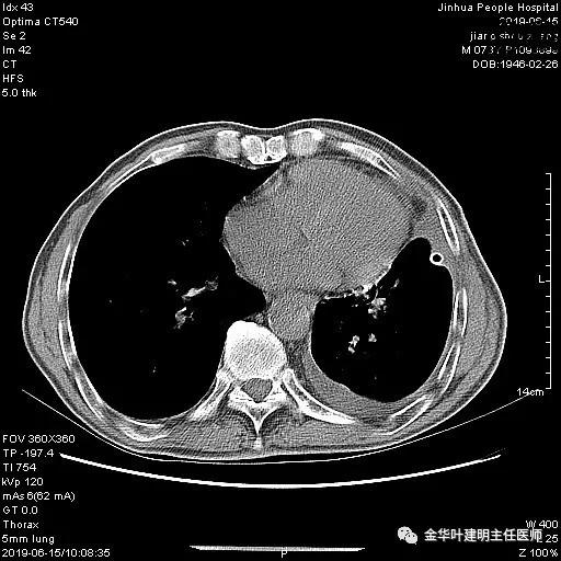 肺手术后乳糜胸是医疗事故吗,肺部切除后乳糜胸治好了
