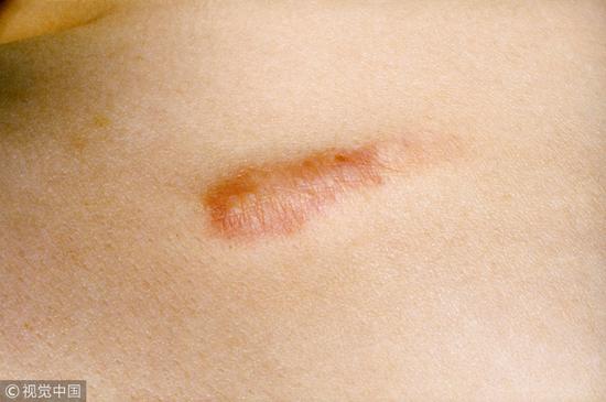伤口结痂了防止留疤的小妙招,伤口愈合后疤痕凸起关注事项