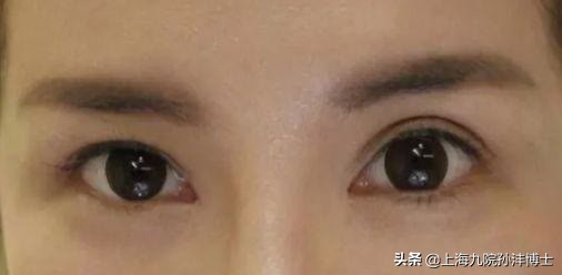 19岁全切双眼皮恢复图真实,眼修复手术