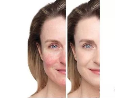 红血丝皮肤护理方案话术,红血丝肌肤的护理方法