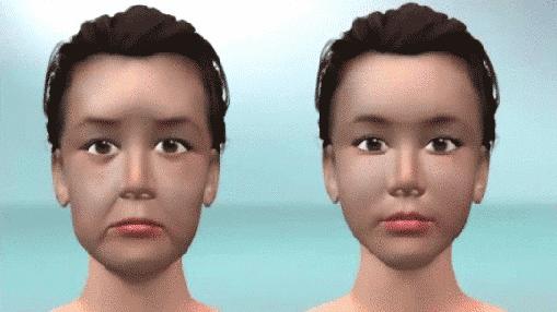 线雕术后的关注事项,线雕鼻术后关注事项