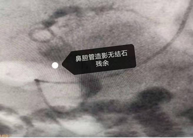 精益求精镜亦求净哈医大一院消化内科ERCP下取净胆管内2.5cm巨型结石