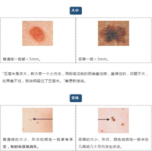 医生提醒这3种痣可能与癌症有关,长在哪些地方的痣都要切